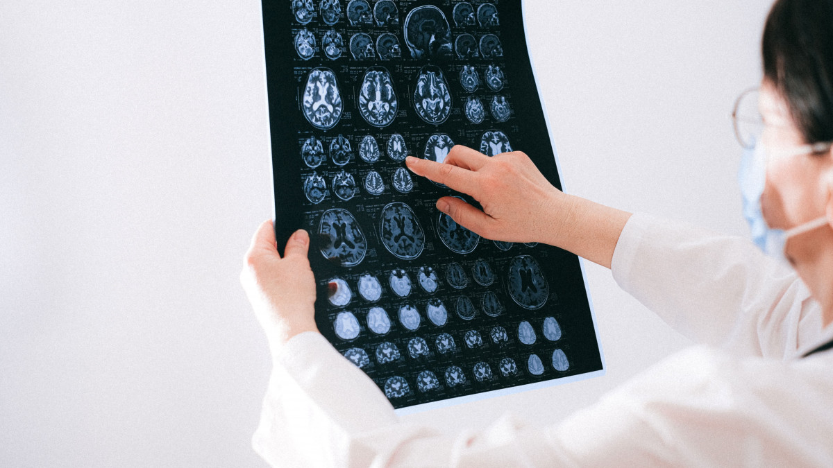 image of doctor looking at brain scan